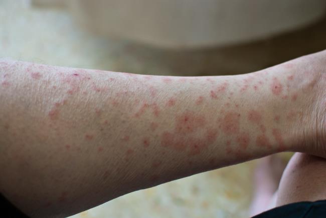 rashes on forearm from poison ivy