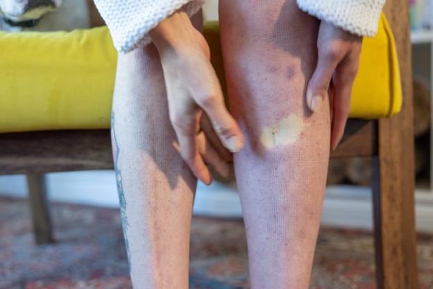 Fingers are seen pressing into a leg that is visibly red with indent lines left from tight compression stockings. 