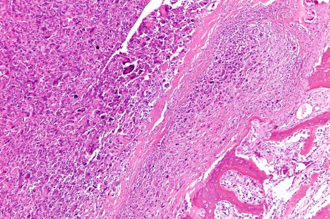 50-facts-a<em></em>bout-osteosarcoma