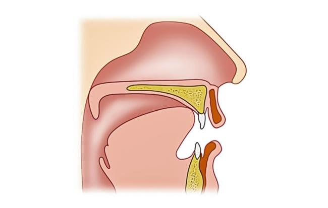 40-facts-a<em></em>bout-velopharyngeal-incompetence