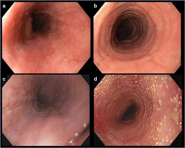 40-facts-a<em></em>bout-eosinophilic-gastroenteritis