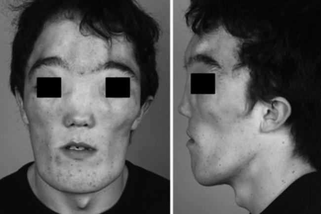 30-facts-a<em></em>bout-craniome<em></em>taphyseal-dysplasia-recessive-type