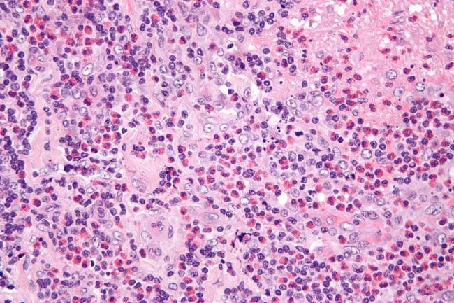 30-facts-a<em></em>bout-eosinophilic-lymphogranuloma