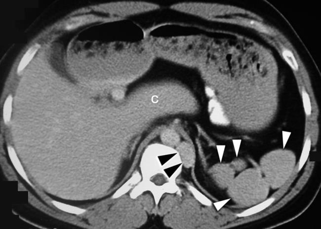 30-facts-a<em></em>bout-pancreas-agenesis