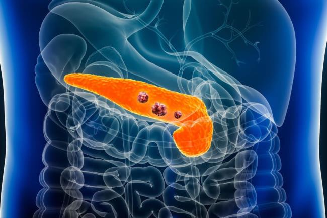 40-facts-a<em></em>bout-pancreatic-carcinoma