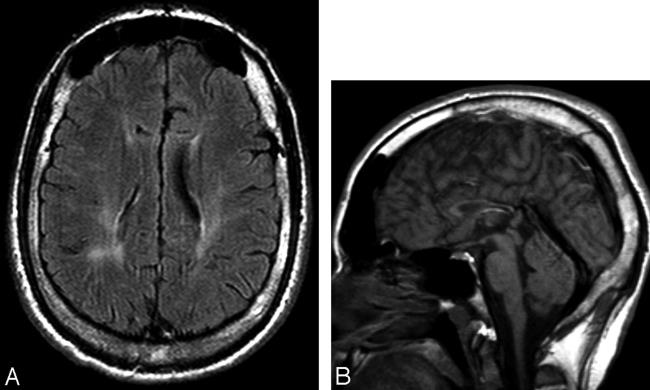 50-facts-a<em></em>bout-hereditary-spastic-paraplegia