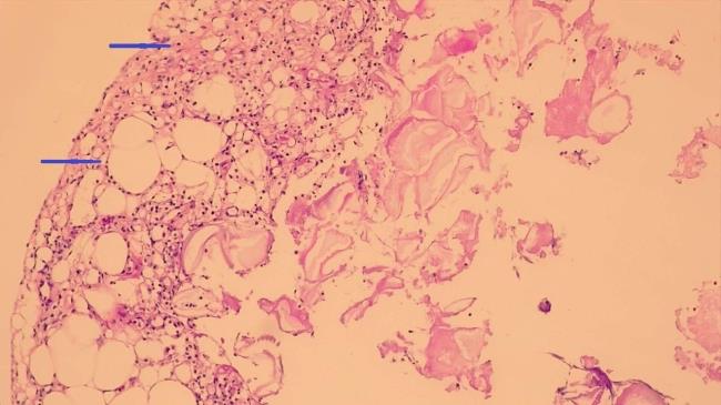 50-facts-a<em></em>bout-mesenteric-panniculitis