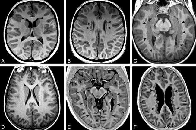 30-facts-a<em></em>bout-hereditary-nodular-heterotopia