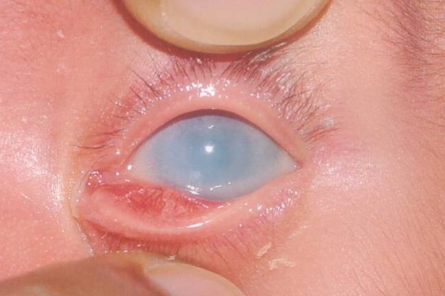 40-facts-a<em></em>bout-sclerocornea