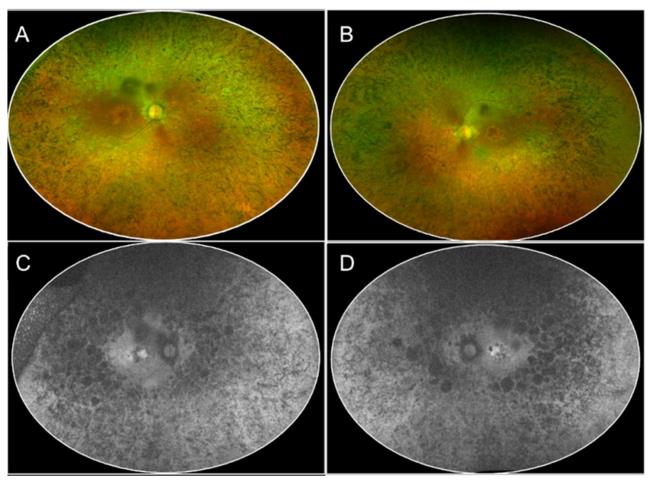 25-facts-a<em></em>bout-retinal-dysplasia-x-l<em></em>inked