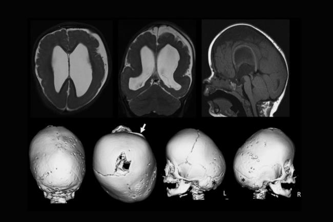 25-facts-a<em></em>bout-polymicrogyria-turricephaly-hypogenitalism