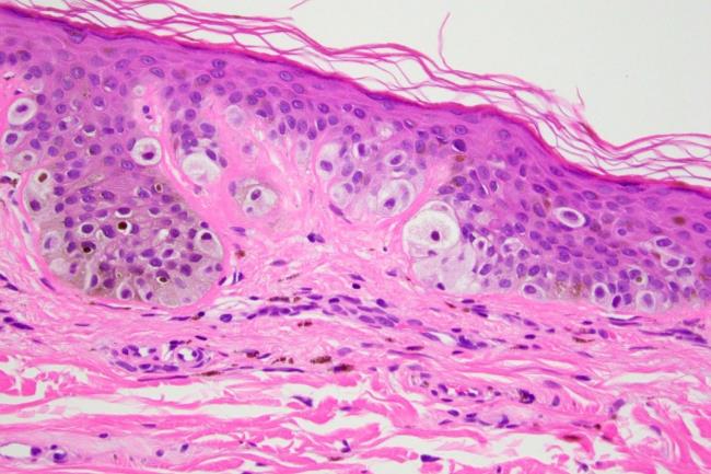 35-facts-a<em></em>bout-procarcinoma