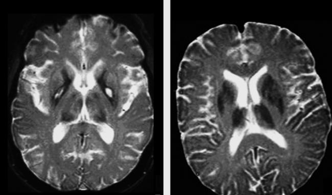 25-facts-a<em></em>bout-striatonigral-degeneration-infantile