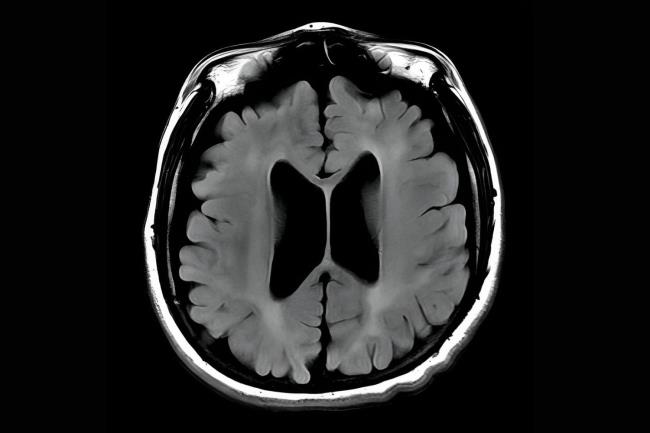 45-facts-a<em></em>bout-pelizaeus-merzbacher-disease